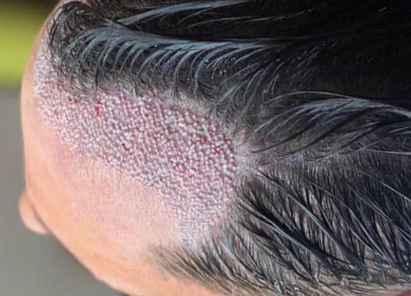 Unshaven Hair Transplant